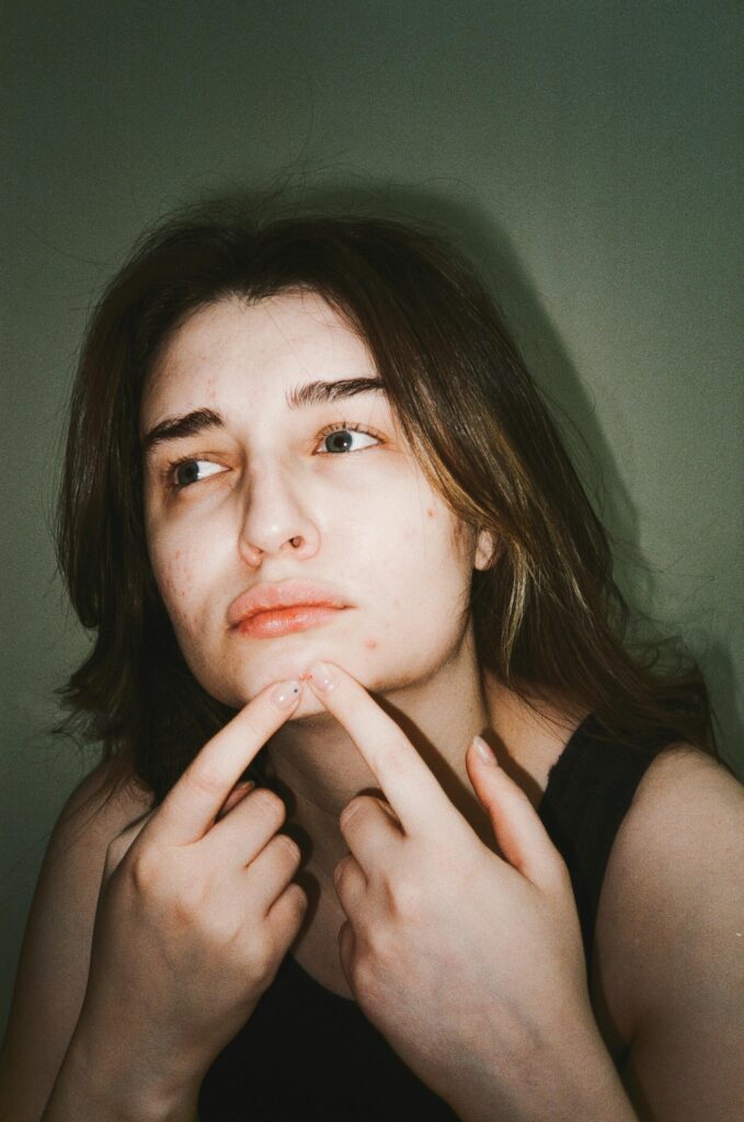 Close-up of a young woman touching her face, addressing acne concerns.