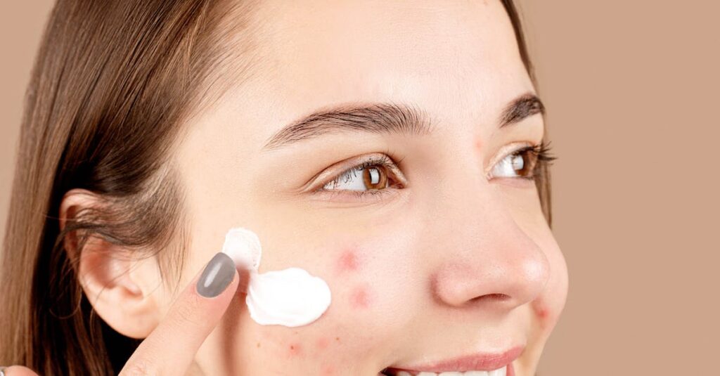 Young woman smiling while applying cream to acne-affected skin, promoting skincare routine.