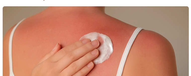 An individual is trying to find the best treatment for sunburned skin by applying a cream to the affected area.
